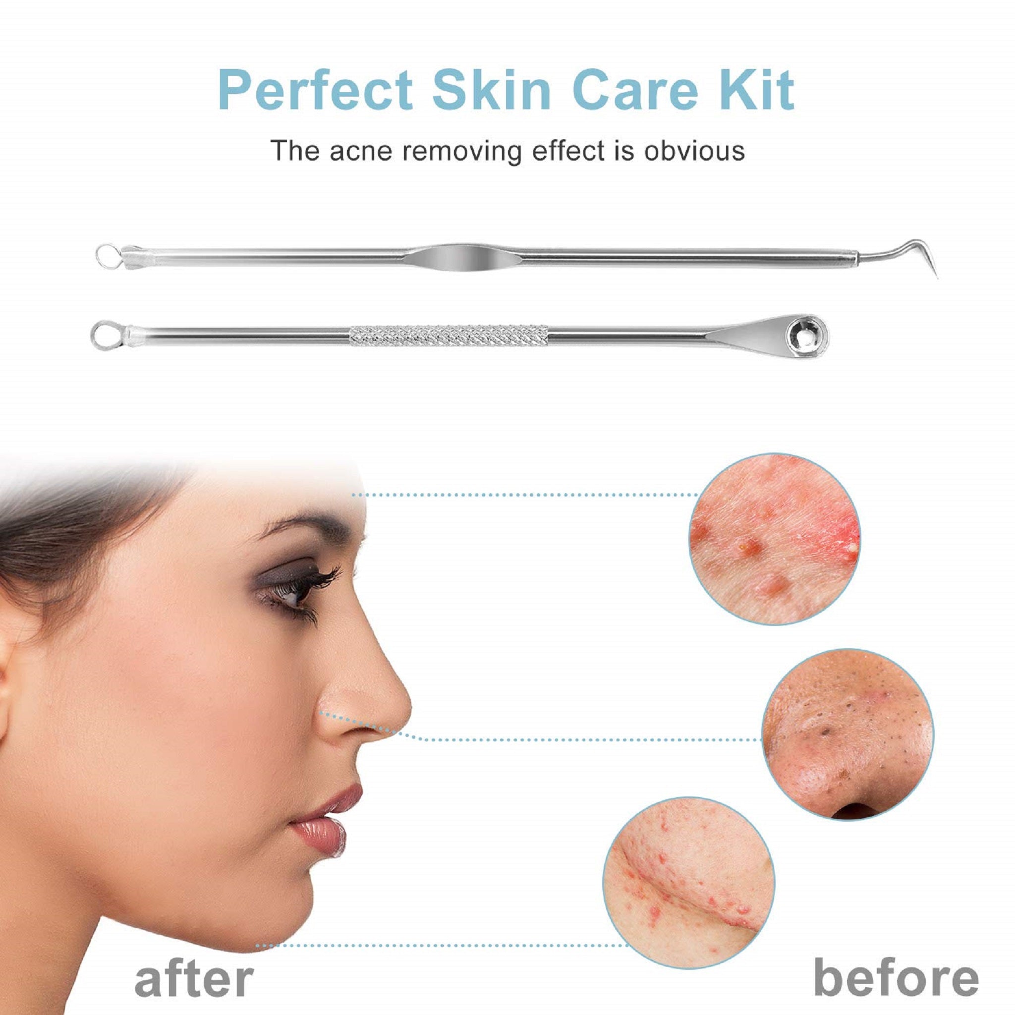 Acne blackhead removal needles